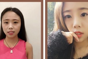 廈門現(xiàn)代口腔門診部耿繼紅整形價格表附牙齒隱形矯正案例展示