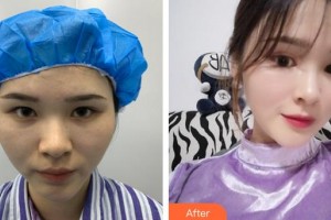 莆田海峽整形美容醫(yī)院魏紫林整形價格表附鼻部手術(shù)案例展示