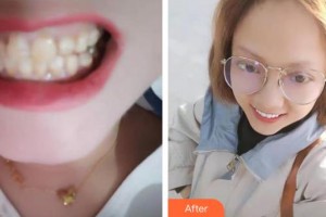 莆田雅美佳口腔醫(yī)院林俊杰整形價(jià)格表附口腔案例展示
