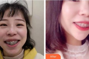 莆田群益口腔門診部徐超凡整形價(jià)格表附金屬托槽矯正牙齒案例展示