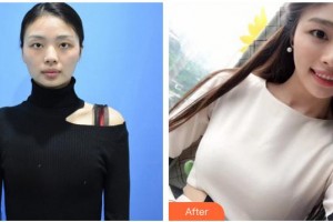 三明市第二醫(yī)院醫(yī)學(xué)美容科陳國章整形價(jià)格表附自體脂肪隆胸案例展示