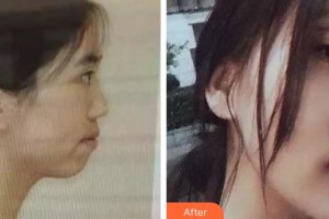 泉州美萊華美整形美容醫(yī)院黃振杰整形價(jià)格表附金屬托槽矯正案例展示