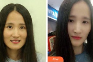 泉州歐菲醫(yī)療美容門(mén)診部王忠政整形價(jià)格表附瓷貼面案例展示