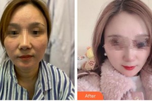 泉州歐菲醫(yī)療美容門(mén)診部姚果整形價(jià)格表附埋線提升日記案例展示