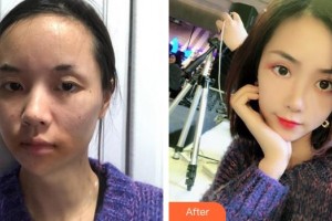 泉州歐菲醫(yī)療美容門(mén)診部饒嘉玲整形價(jià)格表附多方面部埋線提升案例展示