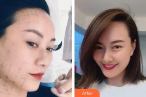 泉州歐菲醫(yī)療美容門(mén)診部方暖碩整形價(jià)格表附熱瑪吉案例展示
