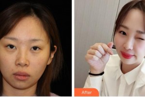 泉州娉娉淑女醫(yī)療美容診所鄭凱整形價(jià)格表附熱瑪吉案例展示