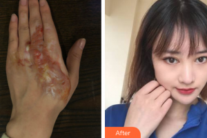 廣州瑞港醫(yī)療美容門診部張兆霞整形價格表附燙傷疤痕案例展示