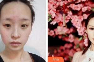 泉州美萊華美整形美容醫(yī)院吳海燕住院醫(yī)師整形價格表附眼部手術(shù)+鼻部手術(shù)案例展示
