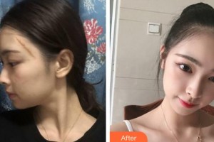 泉州西華醫(yī)療美容醫(yī)院劉建芳整形價格表附疤痕案例展示