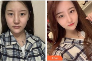 泉州億星醫(yī)療美容門診部李家廣整形價格表附半肋鼻部手術(shù)案例展示