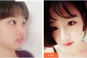 泉州海峽醫(yī)療美容醫(yī)院鄭愛萍整形價格表附超激光美膚案例展示