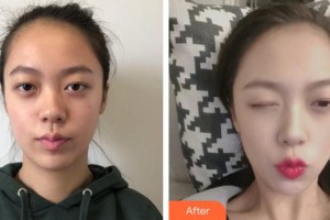 泉州康橋醫(yī)療美容門診部張迪整形價格表附熱瑪吉案例展示