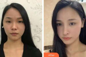 泉州美萊華美醫(yī)療美容門診部楊和強整形價格表附鼻部手術(shù)案例展示