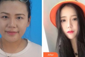 泉州愛爾眼科醫(yī)院金麗文整形價格表附眼部手術-萌系貓式電眼案例展示