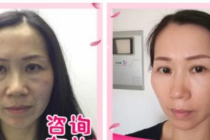 漳州正興醫(yī)院醫(yī)療美容中心陳紅整形價格表附不開刀去眼袋案例展示