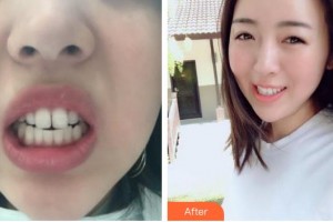 漳州衛(wèi)生職業(yè)學院附屬口腔醫(yī)院方雅君整形價格表附隱形矯正案例展示
