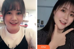 漳州衛(wèi)生職業(yè)學院附屬口腔醫(yī)院鄧潔如整形價格表附金屬托槽矯正案例展示