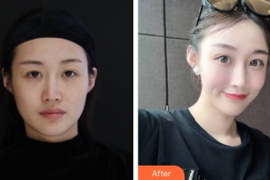 廣州凱美達(dá)整形美容醫(yī)院周玲整形價格表附熱瑪吉抗衰案例展示