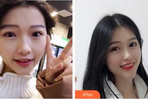 漳州佳美口腔門診部黃志達整形價格表附隱形矯正案例展示
