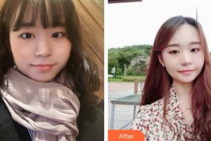 龍巖歐菲醫(yī)療美容門診部劉燕整形價(jià)格表附激光美膚激光案例展示