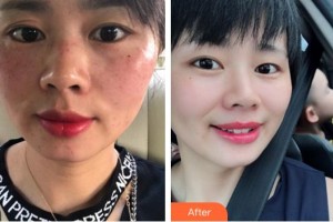 龍巖博愛醫(yī)院整形美容中心林珍娘整形價(jià)格表附超激光美膚案例展示