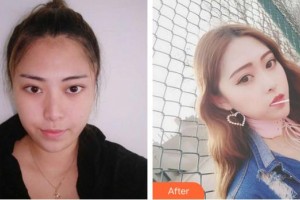 寧德442醫(yī)院整形美容中心趙巖整形價(jià)格表附可愛多變美日記案例展示