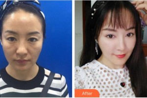 寧德東韓整形美容醫(yī)院莊載世整形價(jià)格表附埋線提升案例展示