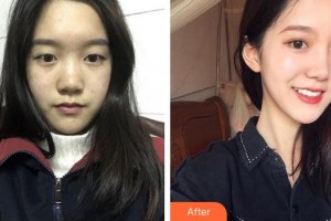寧德眼科醫(yī)院李小霞整形價(jià)格表附雙眼皮+開眼角+提肌案例展示