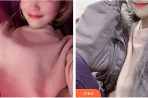 寧德中富口腔醫(yī)院周海燕整形價(jià)格表附超聲波潔牙案例展示