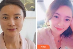 安徽立新醫(yī)學(xué)美容門診部徐商熏整形價(jià)格表附半年的韓式全切雙眼皮案例展示
