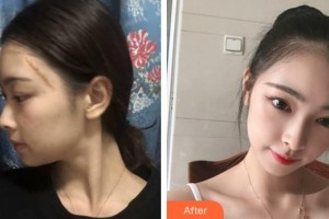 武警安徽總隊(duì)醫(yī)院皮膚美容科陳政利整形價格表附疤痕案例展示
