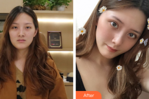 廣州美詩沁醫(yī)療美容門診部王連梅整形價(jià)格表附切開雙眼皮案例展示