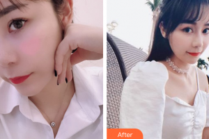 廣州柏德口腔門診部蘭海龍整形價(jià)格表附合金烤瓷牙案例展示