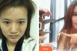 廣州醫(yī)科大學(xué)附屬第一醫(yī)院整形外科張志華整形價(jià)格表附疤痕案例展示