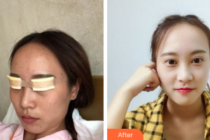 廣州美詩(shī)沁醫(yī)療美容門診部趙占國(guó)整形價(jià)格表附眼部手術(shù)案例展示