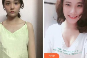 合肥恒美整形醫(yī)院夏言整形價格表附假體隆胸案例展示