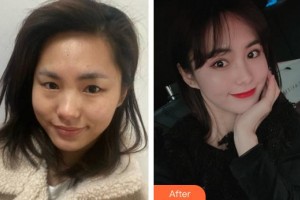 合肥華美整形美容醫(yī)院孫鳳云整形價格表附眼部綜合案例展示