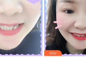合肥麗人女子醫(yī)院中韓整形美容中心吳艷玲整形價格表附牙齒矯正案例展示