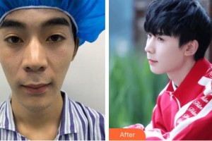 合肥申誠整形美容醫(yī)院魏有志整形價格表附鼻部綜合案例展示
