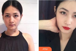 合肥申誠整形美容醫(yī)院盧杰整形價格表附疤痕案例展示