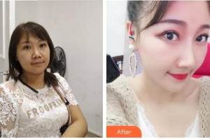 合肥崔勁松醫(yī)療美容診所崔勁松整形價格表附隆鼻案例展示