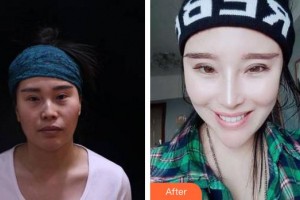 合肥博士整形外科醫(yī)院汪洪源整形價格表附隆鼻案例展示