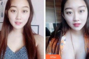 合肥第一人民醫(yī)院整形美容分院姚遠(yuǎn)整形價格表附自體脂肪隆胸案例展示