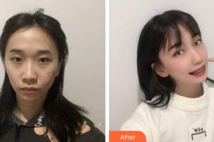 合肥龐博整形美容醫(yī)院李學(xué)恕整形價格表附疤痕案例展示
