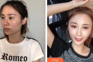 合肥福華醫(yī)療美容醫(yī)院郭孟葵整形價格表附激光祛疤案例展示