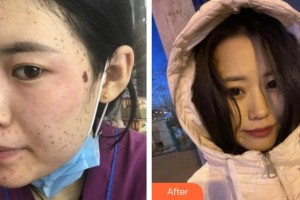 合肥龐博整形美容醫(yī)院謝繼斌整形價格表附激光祛斑案例展示