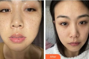合肥第一人民醫(yī)院整形美容分院權(quán)騰整形價格表附祛斑案例展示