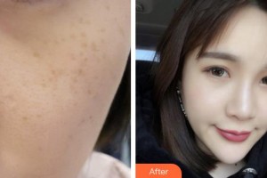 合肥現(xiàn)代婦科醫(yī)院整形美容中心陸玉定整形價格表附激光美膚祛斑案例展示