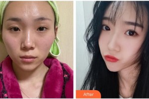 合肥大韓整形美容醫(yī)院衛(wèi)愛俠整形價格表附顴骨內(nèi)推案例展示